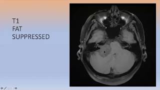 MRI brain demyelinating disorders [upl. by Aicnelev743]