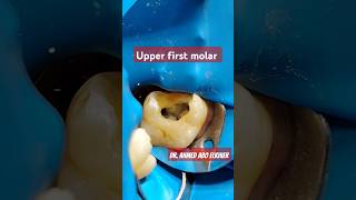 Access Cavity  upper first molar endodontics الكربولة [upl. by Ada]