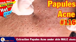 Extraction Papules Acne under skin MALE clients  Acne Treatment 116 [upl. by Anerak]