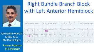 Right bundle branch block with left anterior hemiblock [upl. by Stalder]