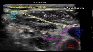 Intermediate cervical plexus block [upl. by Ortrud]