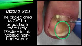 Video  septic toe nail treated by trephining [upl. by Sharline]