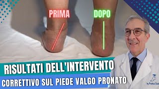 PIEDE VALGO PRONATO Checkup successivo allintervento correttivo  Dott Andrea Scala [upl. by Byrom]