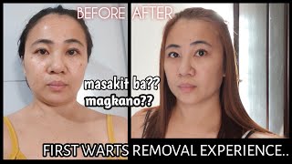 My first warts removal experience face and neck  Electrocautery warts removal [upl. by Cati831]