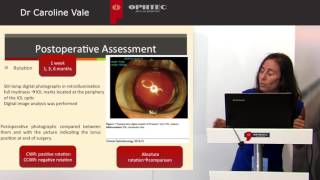 Prospective study Astigmatism management in cataract surgery with Precizon by Dr C Vale [upl. by Pudens]