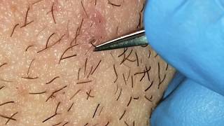 Infected ingrown hairs on neck [upl. by Orazal]