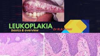 Leukoplakia histopathology [upl. by Fesuoy]