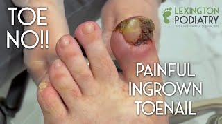 TOE NO Painful Ingrown Toenail Removal [upl. by Opaline]