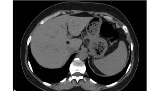 Hepatic Lipoma [upl. by Evelina]