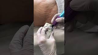 Stretch Marks Inkless Removal Boleyn Treatment Los Angeles 🌍 shorts [upl. by Malamud]