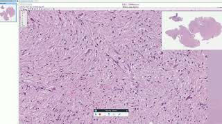 Rosenthal fibers in Pilocytic Astrocytoma  Adventures in Neuropathology [upl. by Vitoria224]