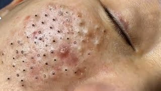 Big Cystic Acne Blackheads Extraction Blackheads amp Milia Whiteheads Removal Pimple Popping  3899 [upl. by Emoreg871]