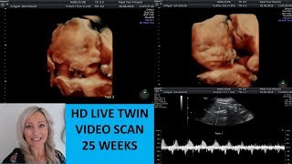 AMAZING LIVE HD TWIN SCAN 25 WEEKS PREGNANT [upl. by Parthena362]