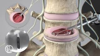 OptiLIF® Endo System  Spineology  4K Animation [upl. by Remsen778]