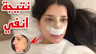 اخيرا نتيجة انفي بعد عملية التجميل 👃🏻 [upl. by Park]