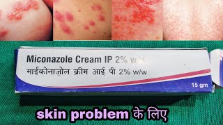 सभी प्रकार के त्वचा इन्फेक्शन में । miconazole cream । का उपयोग किया जा सकता है । चेहरा पर भी [upl. by Bea811]