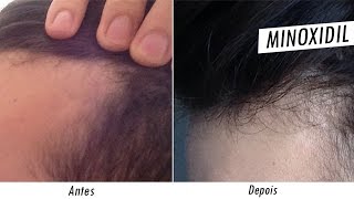 Minoxidil Antes e Depois tratamento contra calvicie [upl. by Akena]