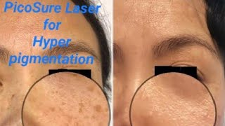 Best laser for pigmentation  picolaser treatment skinrejuvenation draqeel adeelmedics laser [upl. by Noseyt]