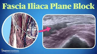 Fascia Iliaca Plane Block [upl. by Adoh]