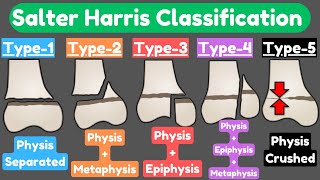 Salter Harris Fracture Classification [upl. by Assenaj]