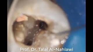 broken file removal with btr pen loop Prof Dr Talal AlNahlawi د طلال النحلاوي [upl. by Lowis]