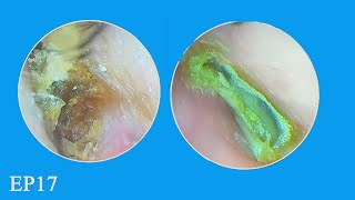 Hard and Impacted Ear Wax Removal Form Eardrum Ep17 asmr earwaxremoval [upl. by Ylrebmic]