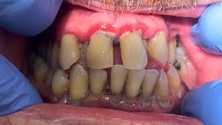 COMPILATION VIDEO OF DENTAL CLEANINGFlossing Brushing [upl. by Aihsel]