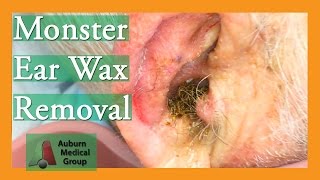 Monster Ear Wax Removal Brings New Life to JOKESTER Patient  Auburn Medical Group [upl. by Herve661]