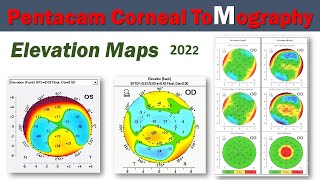 Pentacam Corneal ToMography  Elevation Maps 20 [upl. by Alledi]