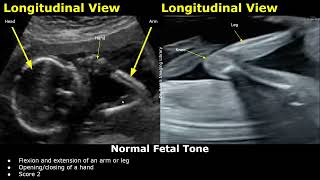 Fetal Biophysical Profile Ultrasound Normal Vs Abnormal Values  Fetus BreathingTone BPSBPP USG [upl. by Aidyn]