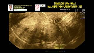 Malignant Ovarian Tumor [upl. by Ferne]