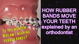 How elastics  rubber bands move teeth time lapse  Braces Explained [upl. by Joye]