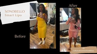 Sono Bello Before and After  The Smart Lipo Journey [upl. by Ahsehyt]