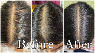 My Honest Hair loss Journey amp How I fixed it [upl. by Halludba]