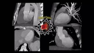 ANGIOTOMOGRAFIA CARDÍACA EM MODO CINE [upl. by Felske755]