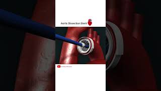 Aortic dissection Stent grafting cardiology shorts [upl. by Maryrose]