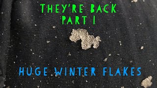 Theyre Back  Huge Winter Flakes Returns Scratchers Anonymous Dandruff ASMR [upl. by Ahsienroc]