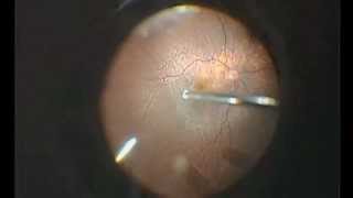 Vitrectomy for dropped lens fragments [upl. by Dombrowski343]