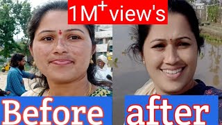 pigmentation నల్ల మచ్చలు ఉంటే ఇలా చేయండిhome remedyhow to remove face pigmentation [upl. by Anuat]