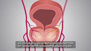 Vergrösserte Prostata ohne Operation behandeln Prostata Embolisation [upl. by Seaton]