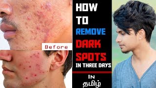 Remove DARK SPOTSBlack Spots In 3 Days IN TAMILSkin Care Tips For Men [upl. by Lat]