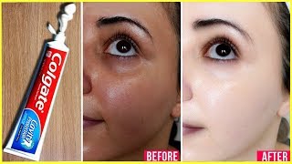 Apply Toothpaste on Your Skin and See Magical Result within 1 Hour ¦Amazing Toothpaste Beauty Hacks [upl. by Acyre286]