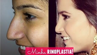 Minha rinoplastia cirurgia no nariz [upl. by Ariik]