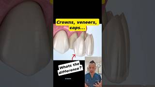 Crowns Veneers or Caps Whats the Difference dentallan dentist shorts [upl. by Llerdna]