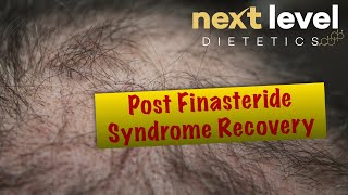 Post Finasteride Syndrome Recovery [upl. by Primalia]