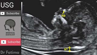 Fetal Nuchal translucency amp Nuchal fold ultrasound by DrFatima [upl. by Aihtenyc631]