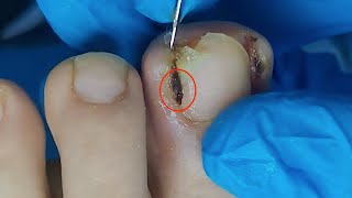 【Daily Pedicure Tutorial】Removing Deeply Embedded Ingrown Toenails on Both Sides of The Big Toe [upl. by Laen]