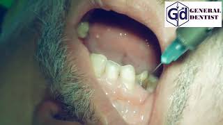 Infiltration anesthesia for treatment 1112 teeth [upl. by Helsa]