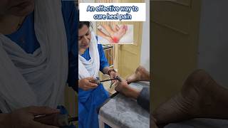 instant relief agnikarma heelpaintreatment ytshorts shortsfeed [upl. by Ahsya236]