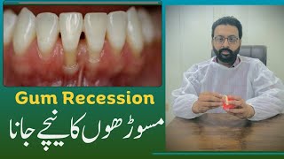 What is gum recession   Can gums grow back   ateeqdentalcare [upl. by Lacefield606]